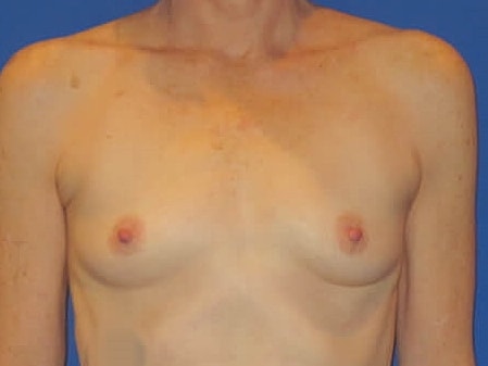 Breast Augmentation Before & After