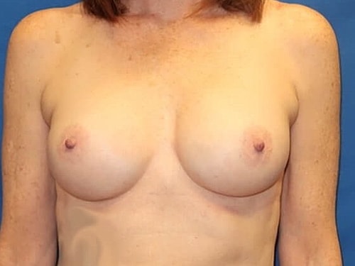 Breast Augmentation Before & After