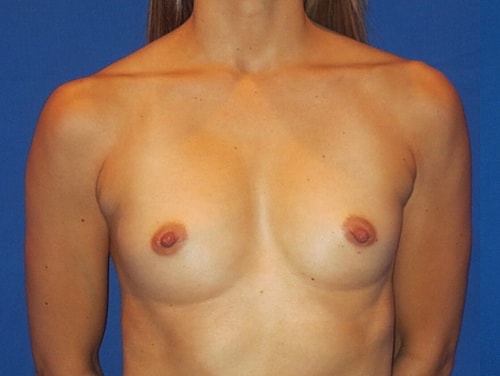 Breast Augmentation Before & After
