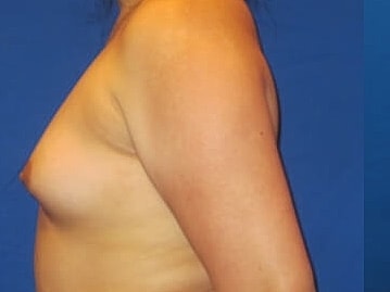 Breast Augmentation Before & After