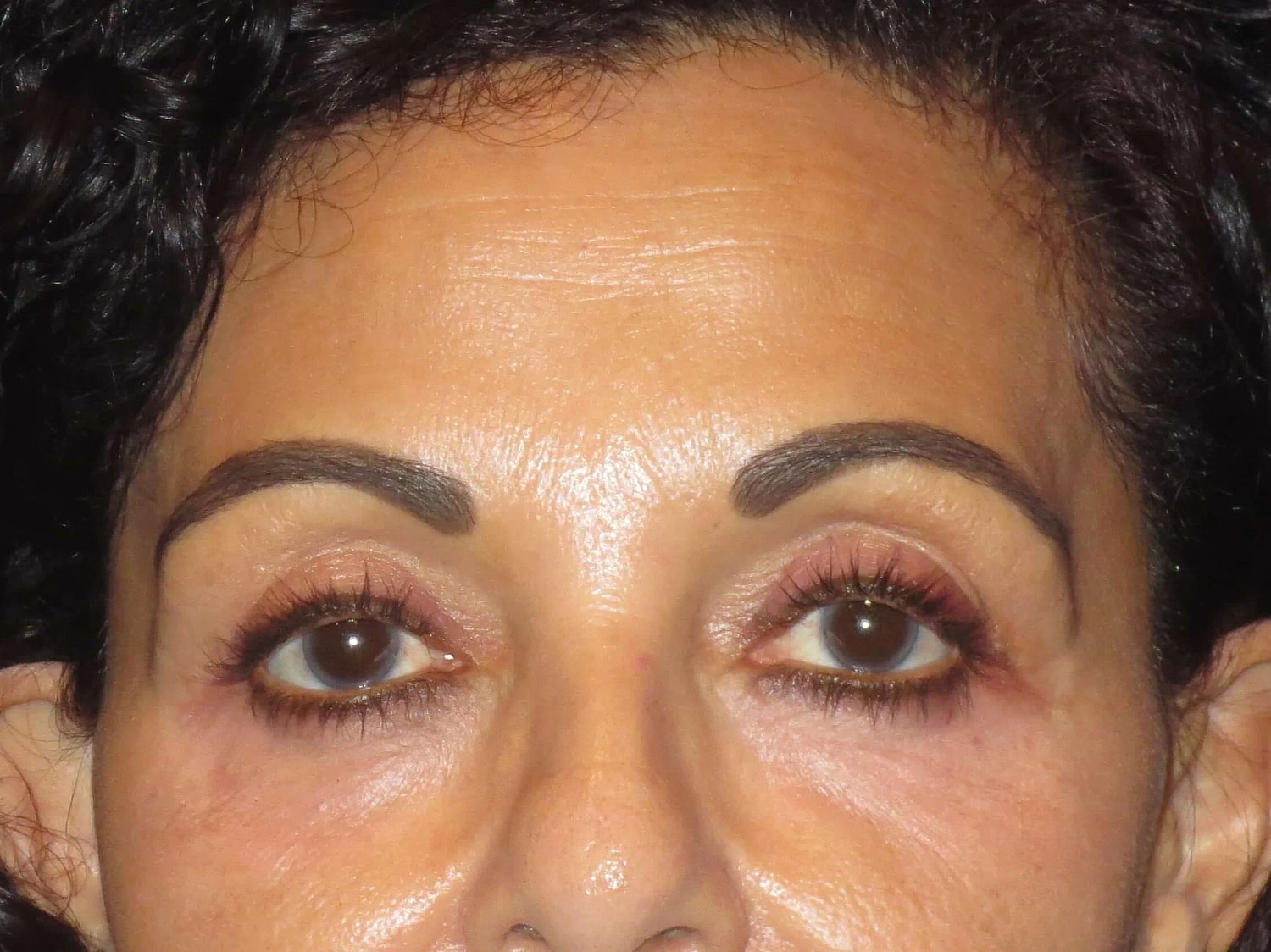 Temple Fillers Before & After