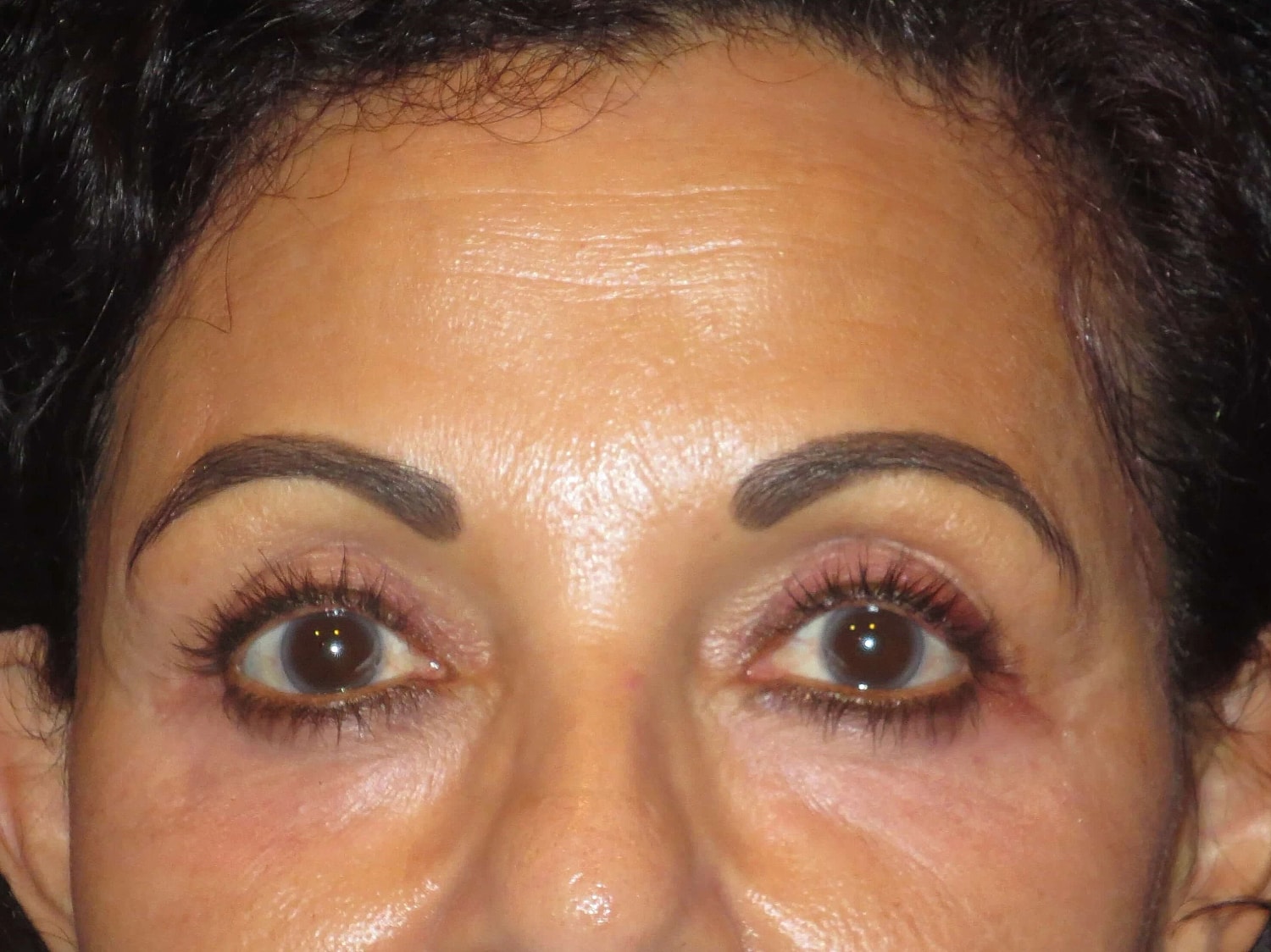 Temple Fillers Before & After