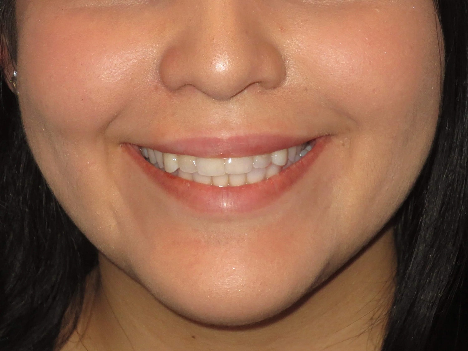 Lip Filler Before & After