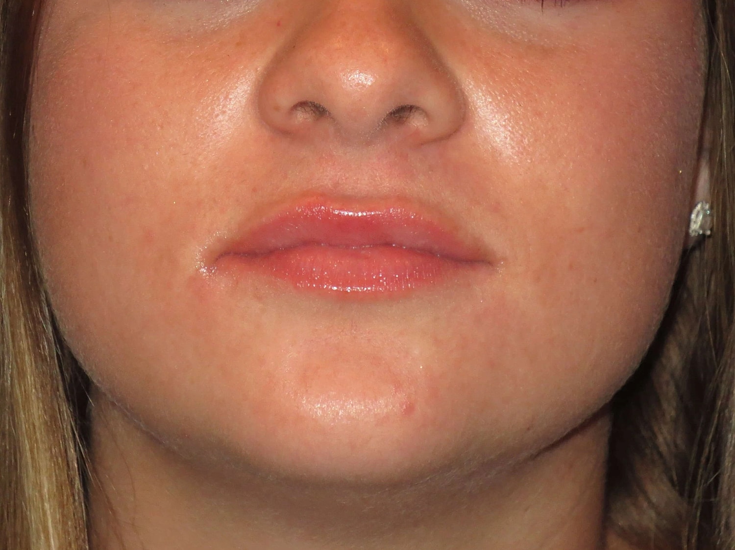 Lip Filler Before & After