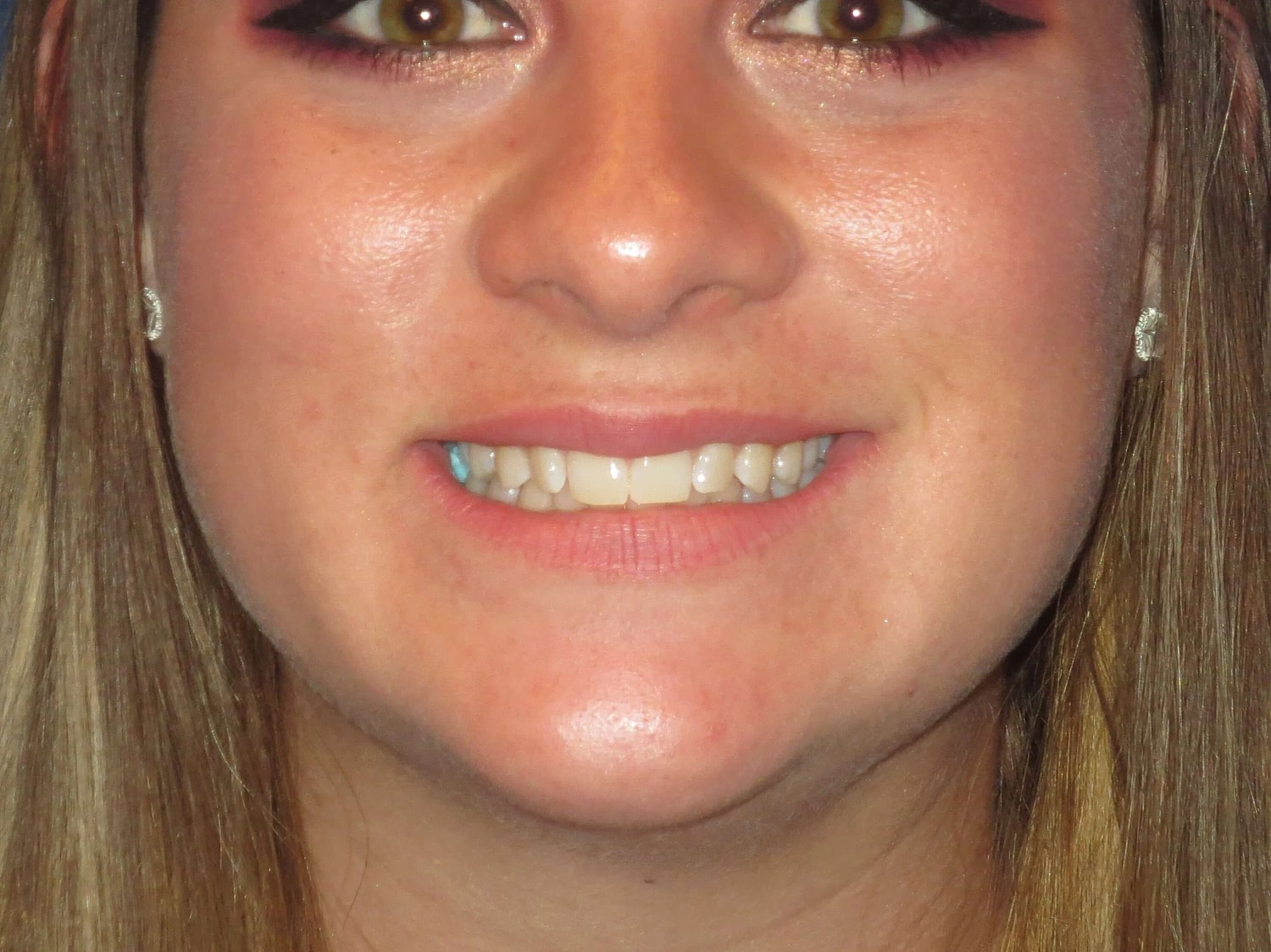 Lip Filler Before & After