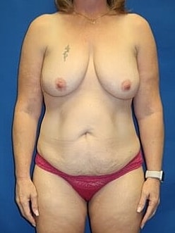 Mommy Makeover Before & After