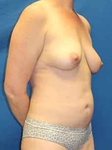 Mommy Makeover Before & After