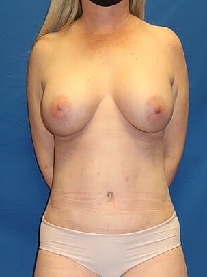 Mommy Makeover Before & After