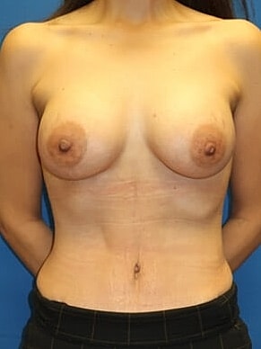 Mommy Makeover Before & After