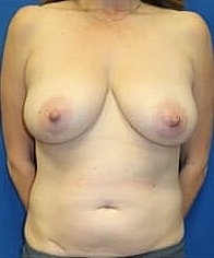 Mommy Makeover Before & After