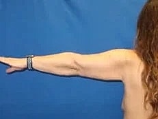 Arm Lift Before & After