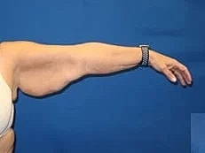 Arm Lift Before & After